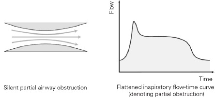 Mediciones del modo AutoSet: limitaci&oacute;n del flujo