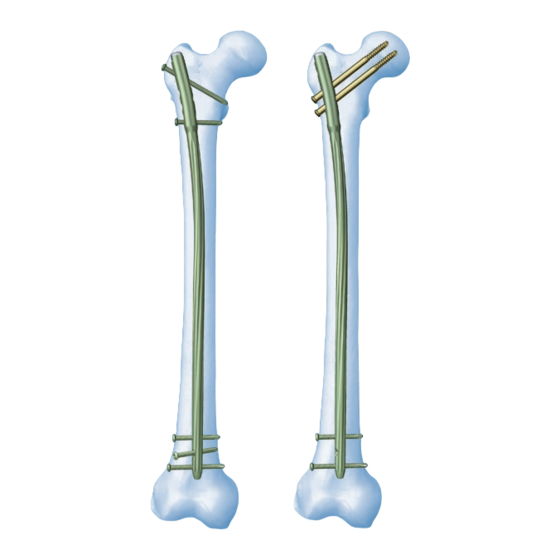 DePuy Synthes EXPERT LFN Manual De Usuario